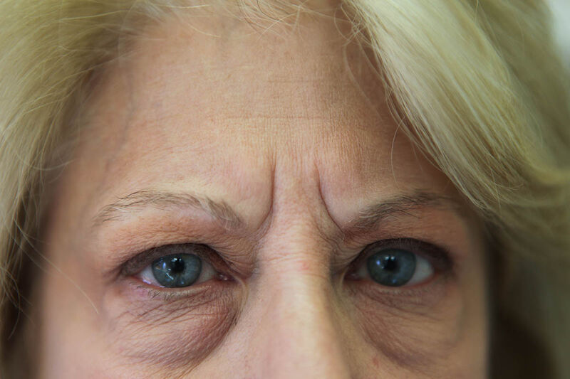 Lower Blepharoplasty Before & After Patient Photo