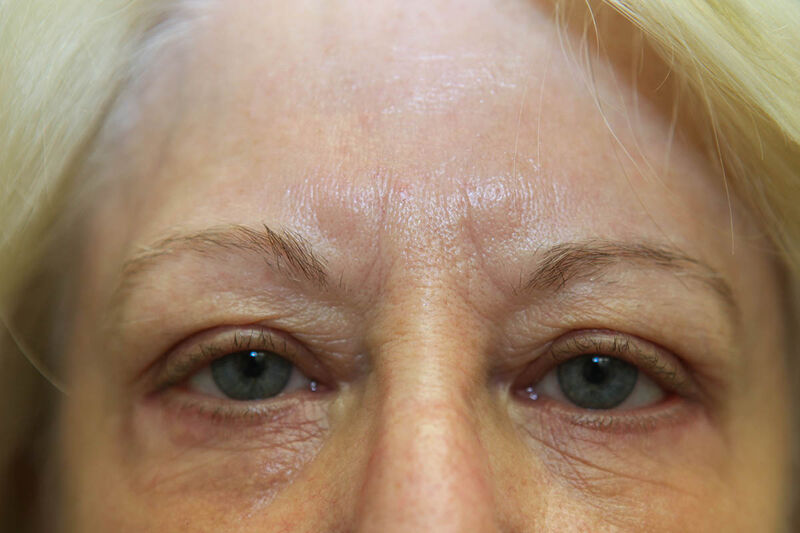 Lower Blepharoplasty Before & After Patient Photo