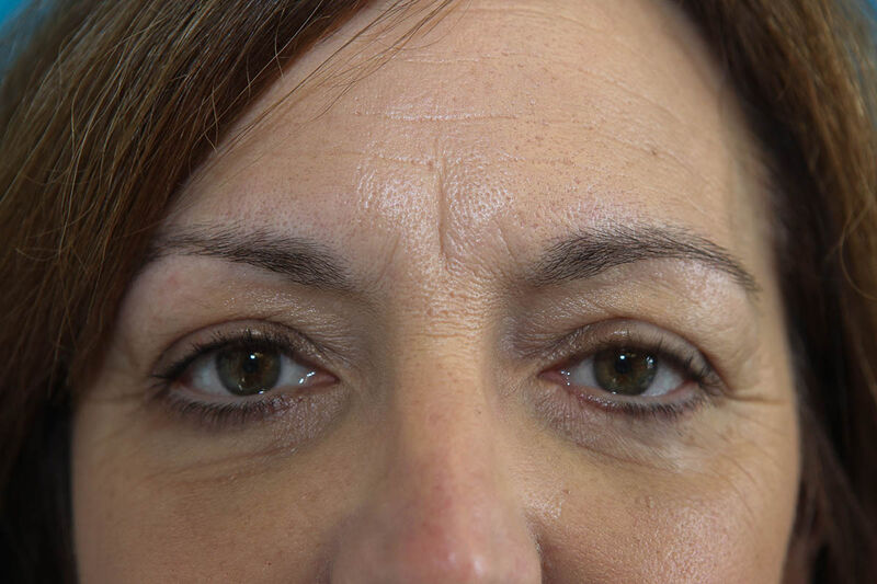 Lower Blepharoplasty Before & After Patient Photo