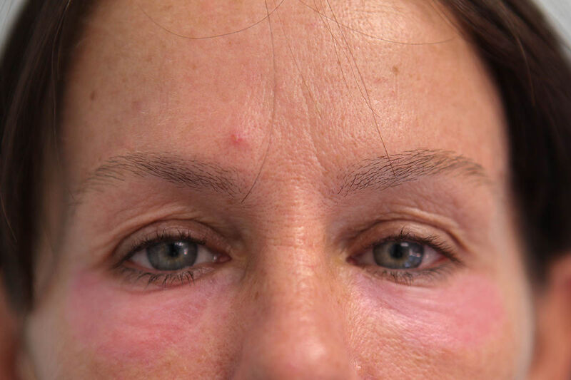 Lower Blepharoplasty Before & After Patient Photo