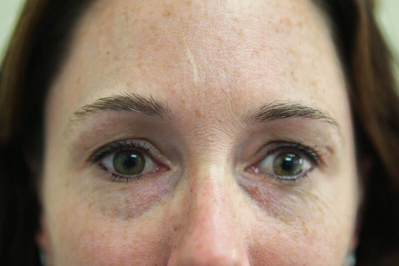 Lower Blepharoplasty Before & After Patient Photo