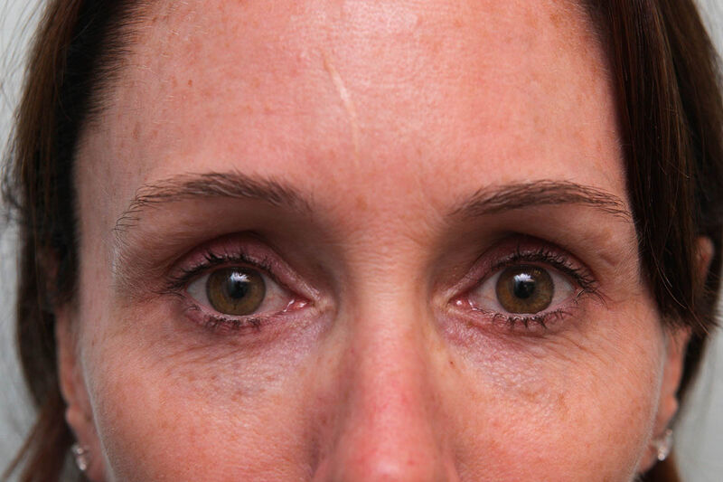 Lower Blepharoplasty Before & After Patient Photo