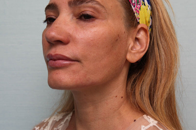 Nefertiti Lift Before & After Patient Photo