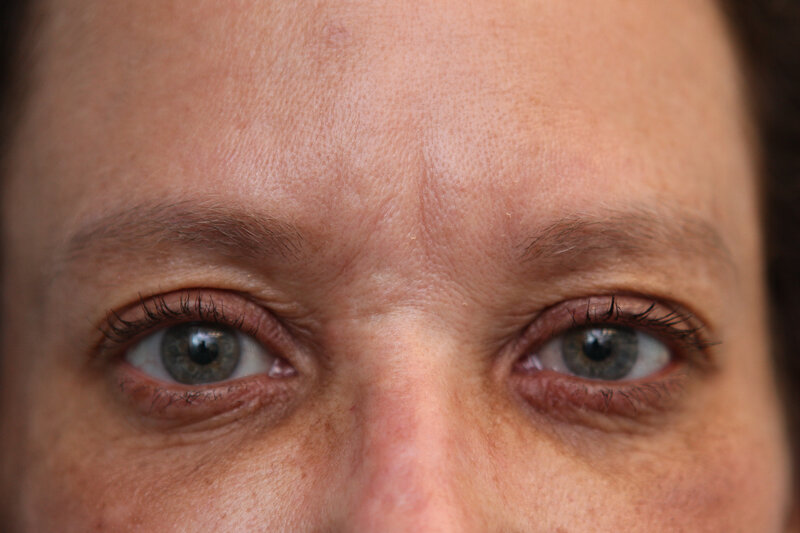 Upper Blepharoplasty Before & After Patient Photo