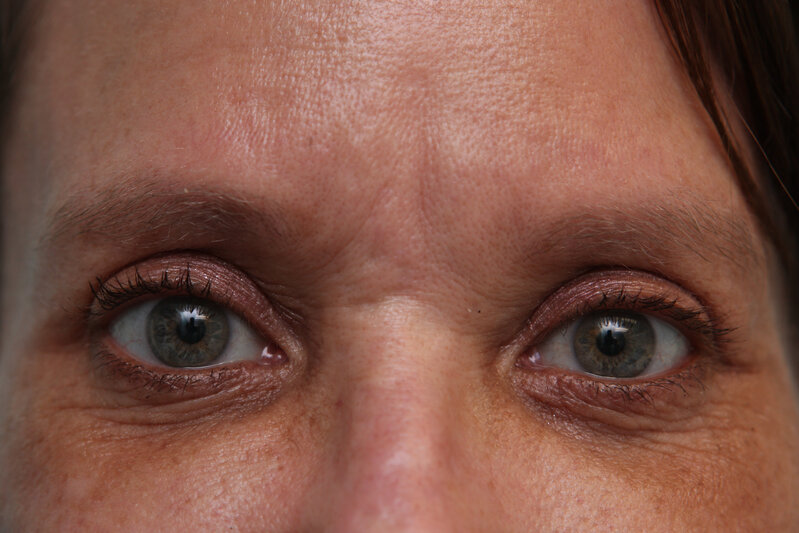 Upper Blepharoplasty Before & After Patient Photo