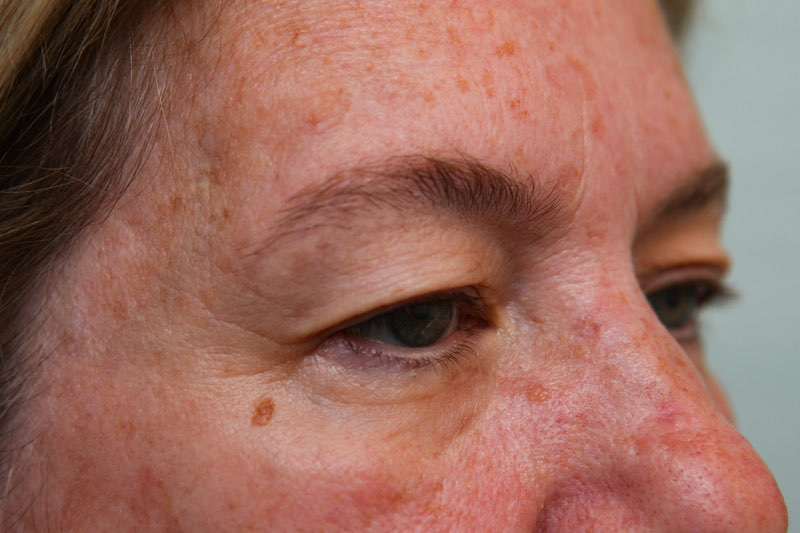 Upper Blepharoplasty Before & After Patient Photo