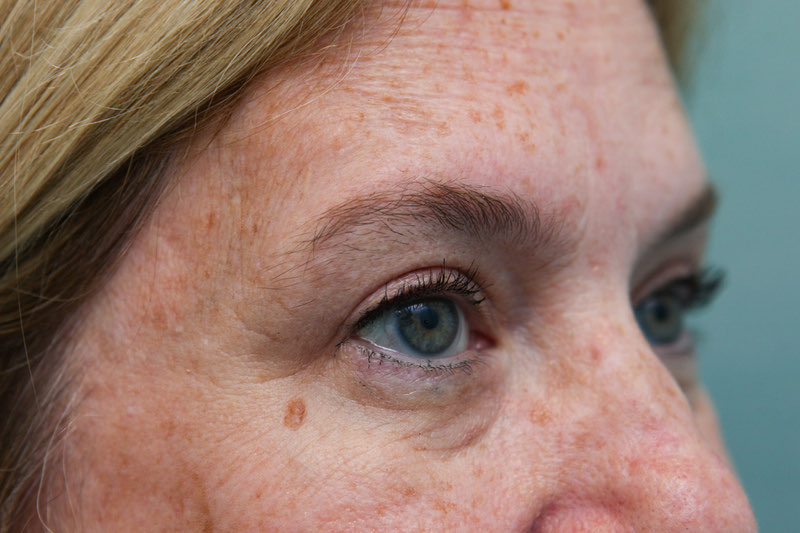Upper Blepharoplasty Before & After Patient Photo