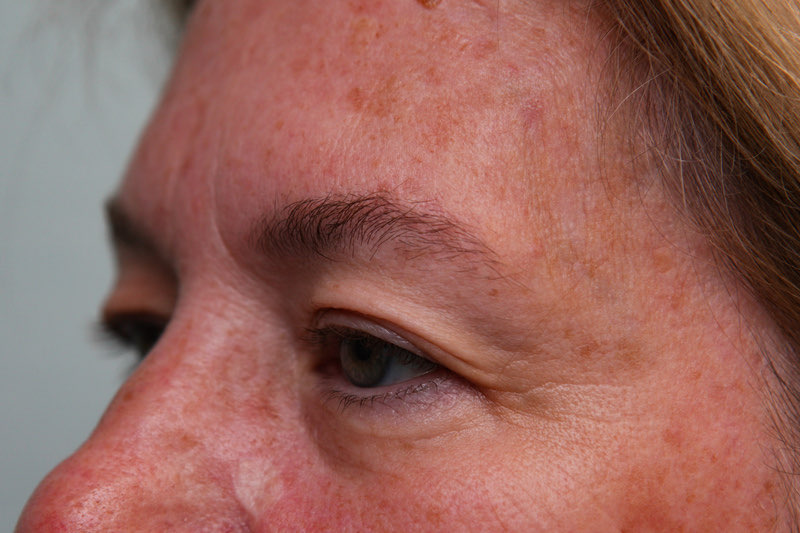 Upper Blepharoplasty Before & After Patient Photo