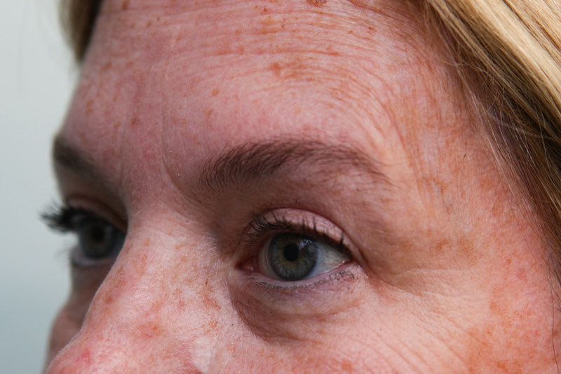 Upper Blepharoplasty Before & After Patient Photo