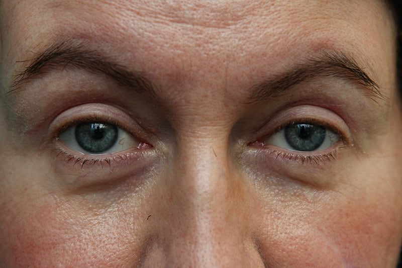 Upper Blepharoplasty Before & After Patient Photo