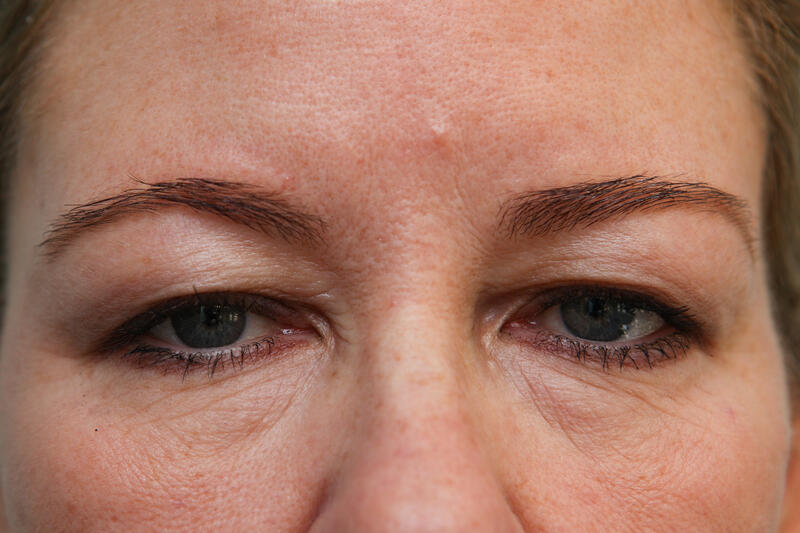 Upper Blepharoplasty Before & After Patient Photo