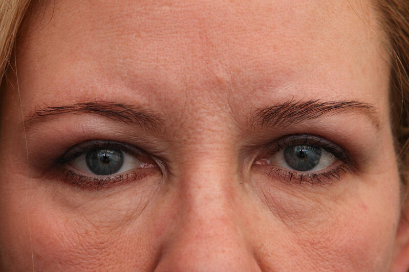 Upper Blepharoplasty Before & After Patient Photo