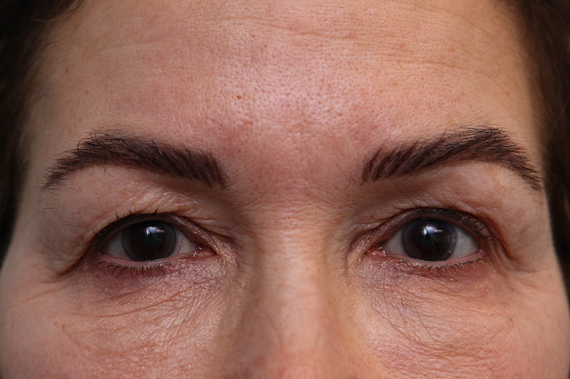 Upper Blepharoplasty Before & After Patient Photo