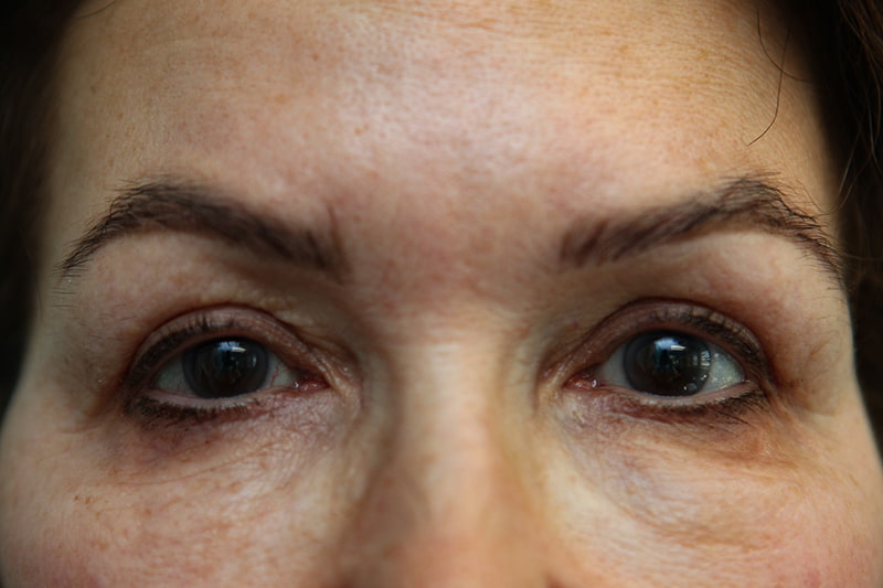 Upper Blepharoplasty Before & After Patient Photo