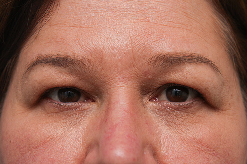 Upper Blepharoplasty Before & After Patient Photo