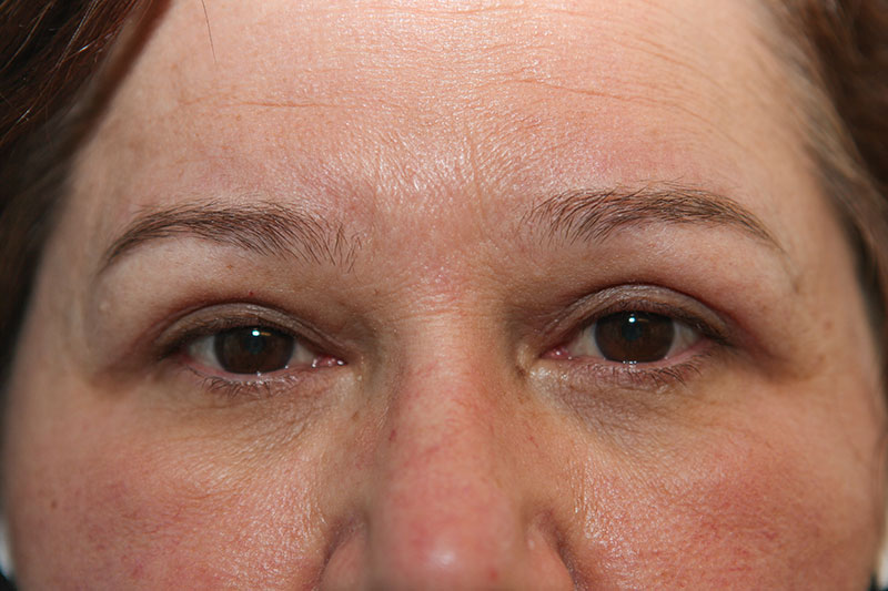 Upper Blepharoplasty Before & After Patient Photo