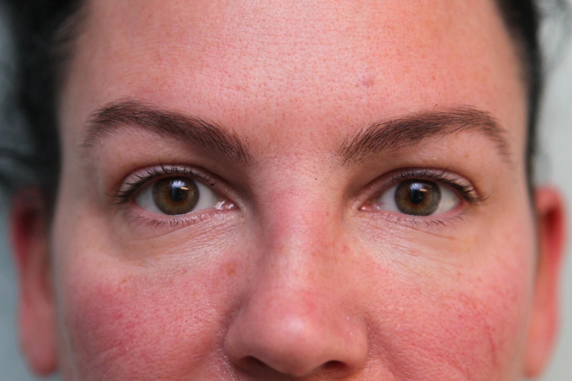 Upper Blepharoplasty Before & After Patient Photo