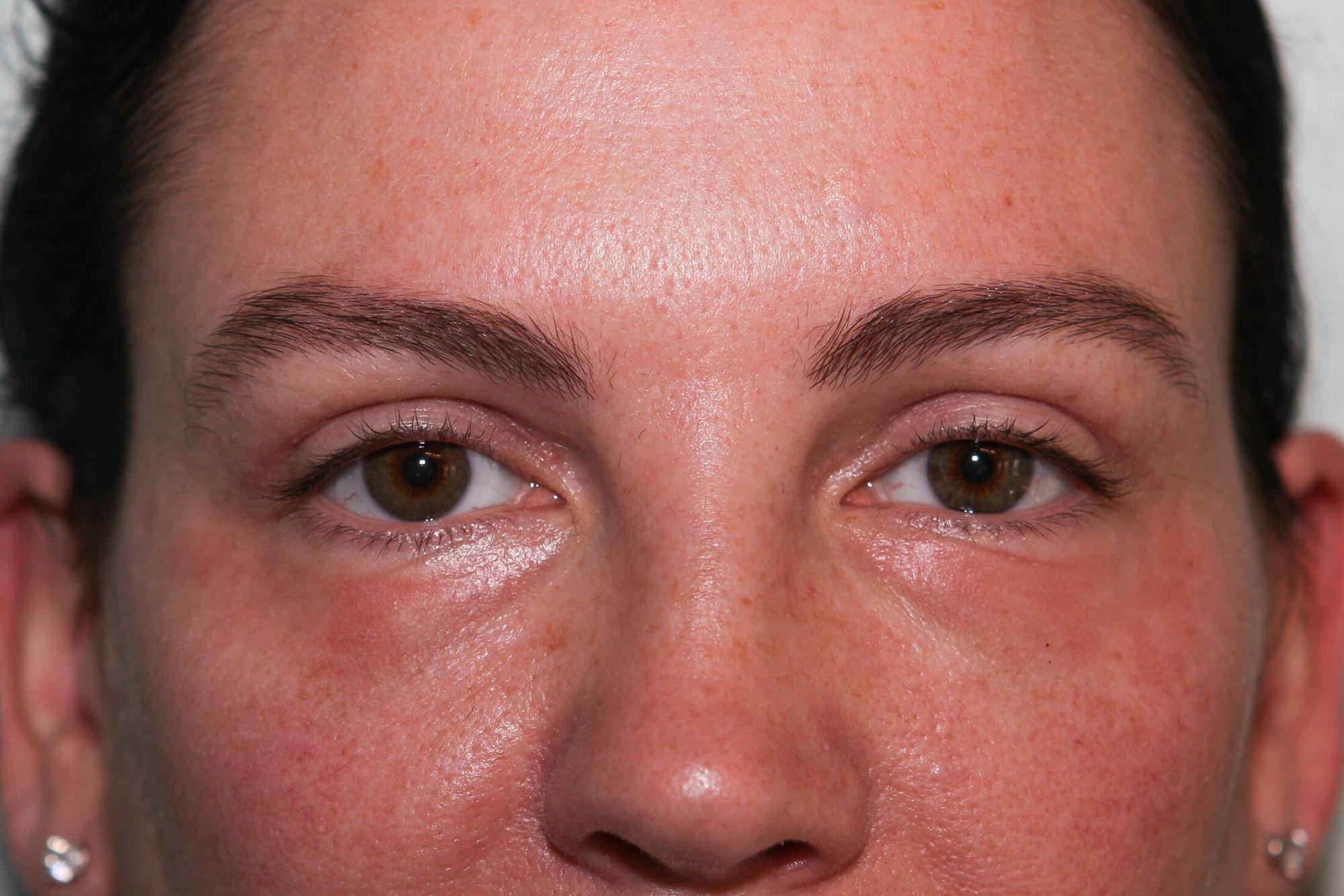 Upper Blepharoplasty Before & After Patient Photo