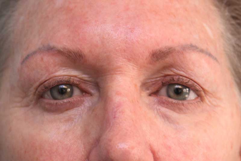 Upper Blepharoplasty Before & After Patient Photo