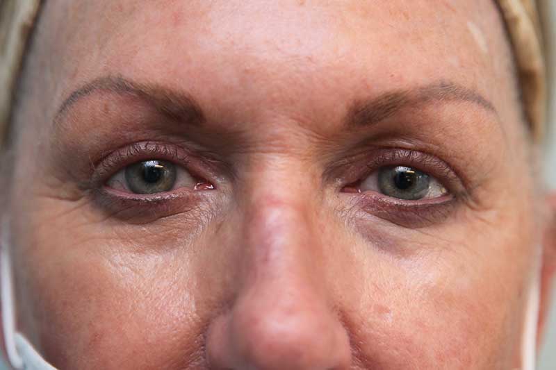 Upper Blepharoplasty Before & After Patient Photo