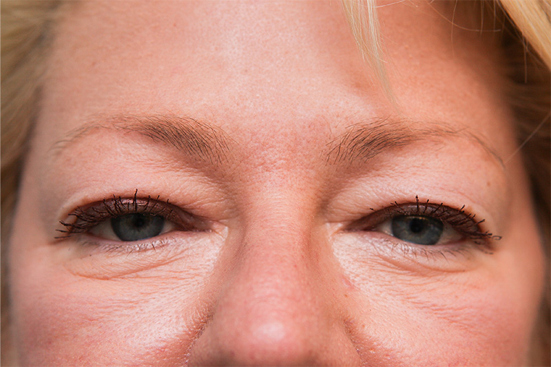 Upper Blepharoplasty Before & After Patient Photo