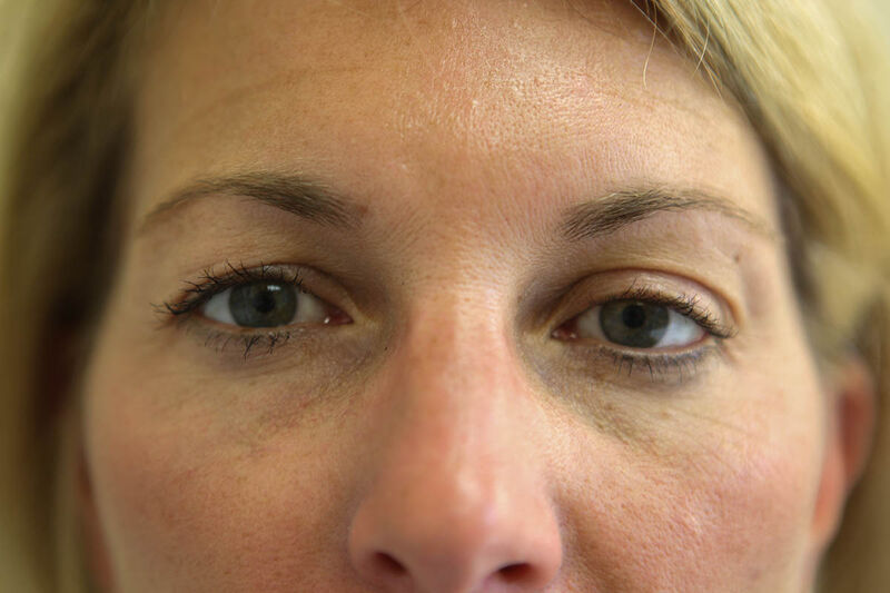 Upper Blepharoplasty Before & After Patient Photo