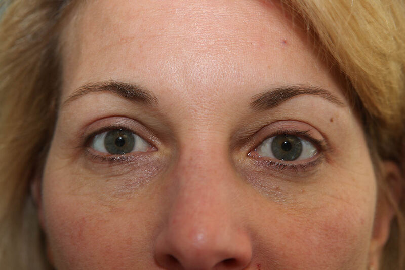 Upper Blepharoplasty Before & After Patient Photo