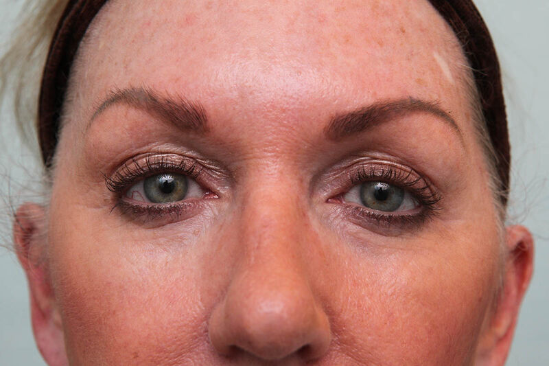 Upper Blepharoplasty Before & After Patient Photo