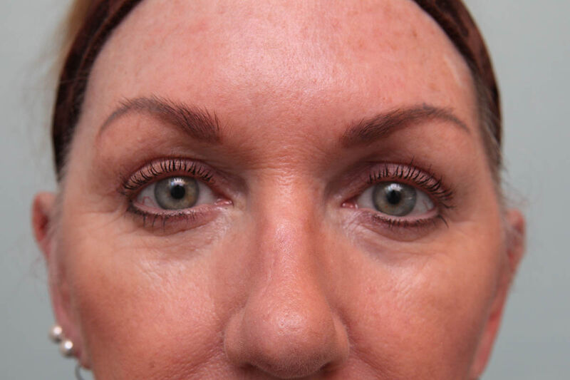 Upper Blepharoplasty Before & After Patient Photo