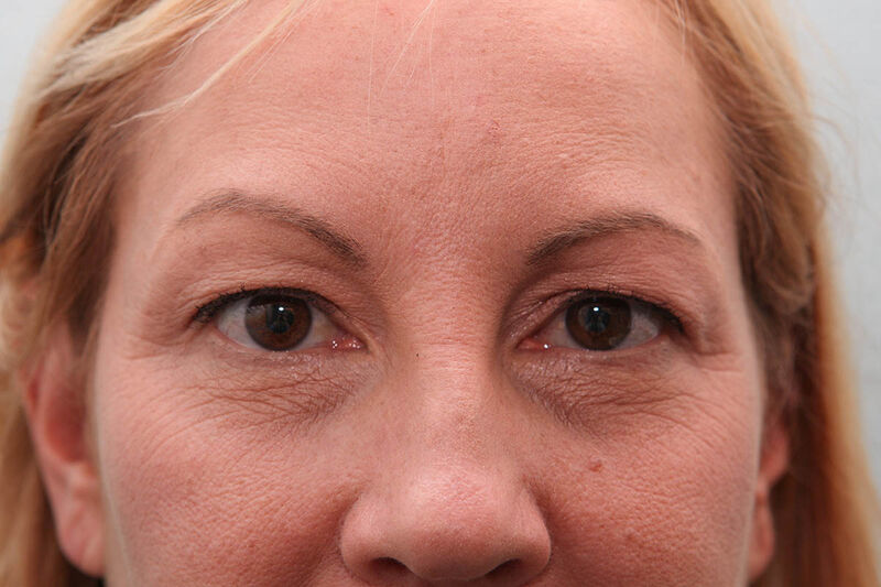 Upper Blepharoplasty Before & After Patient Photo