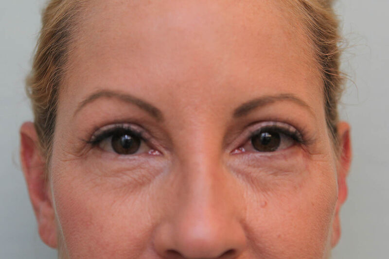 Upper Blepharoplasty Before & After Patient Photo