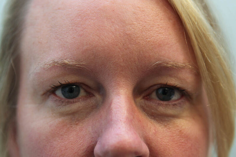 Upper Blepharoplasty Before & After Patient Photo