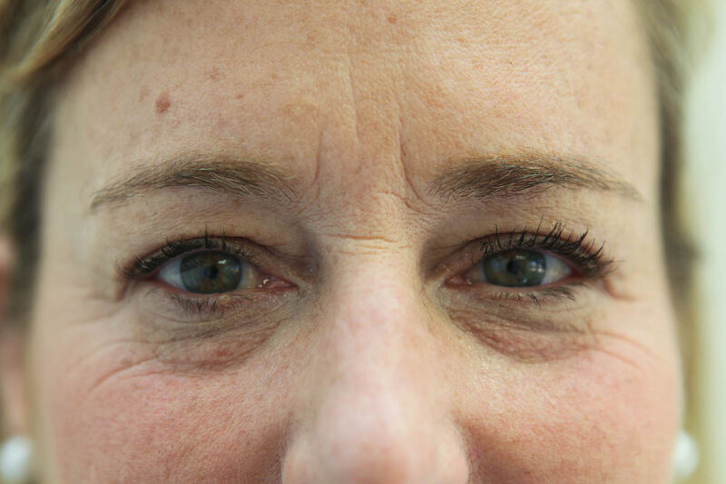 Upper Blepharoplasty Before & After Patient Photo