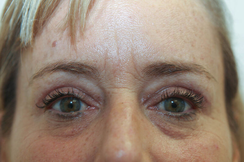 Upper Blepharoplasty Before & After Patient Photo