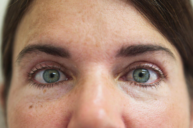 Upper Blepharoplasty Before & After Patient Photo