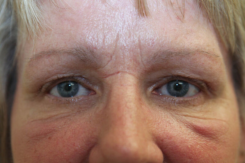 Upper Blepharoplasty Before & After Patient Photo