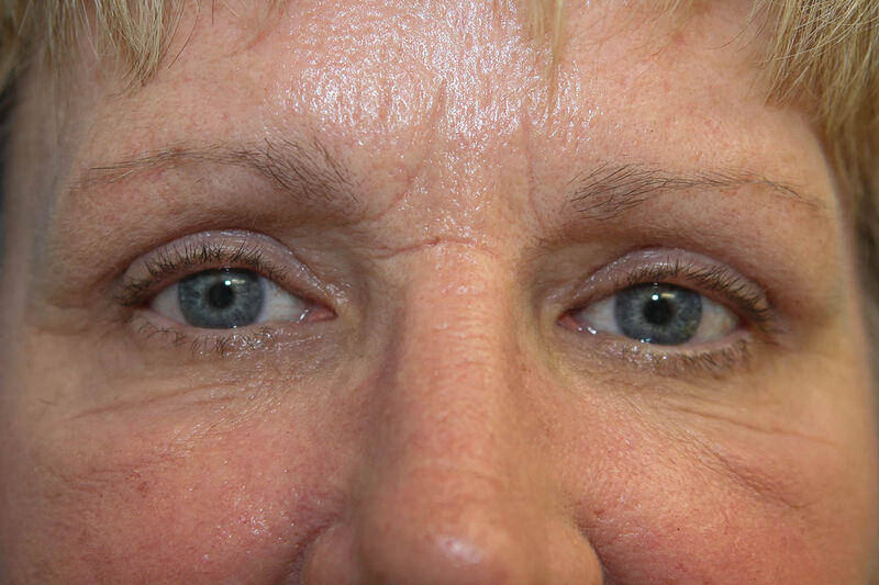 Upper Blepharoplasty Before & After Patient Photo