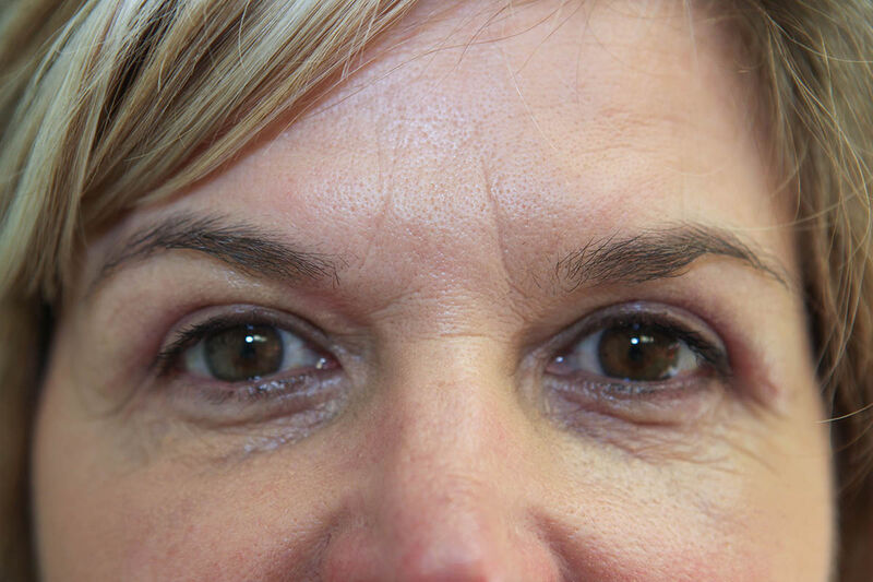 Upper Blepharoplasty Before & After Patient Photo