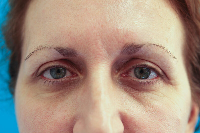 Upper Blepharoplasty Before & After Patient Photo