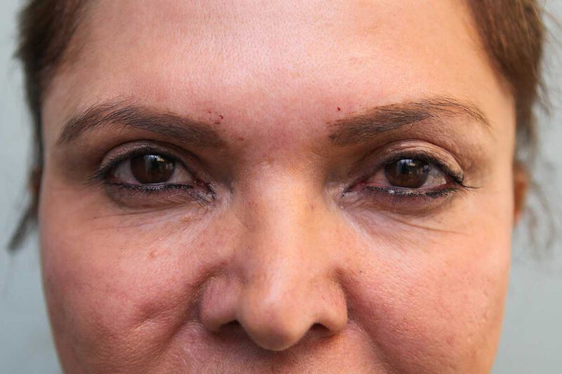 Upper Blepharoplasty Before & After Patient Photo
