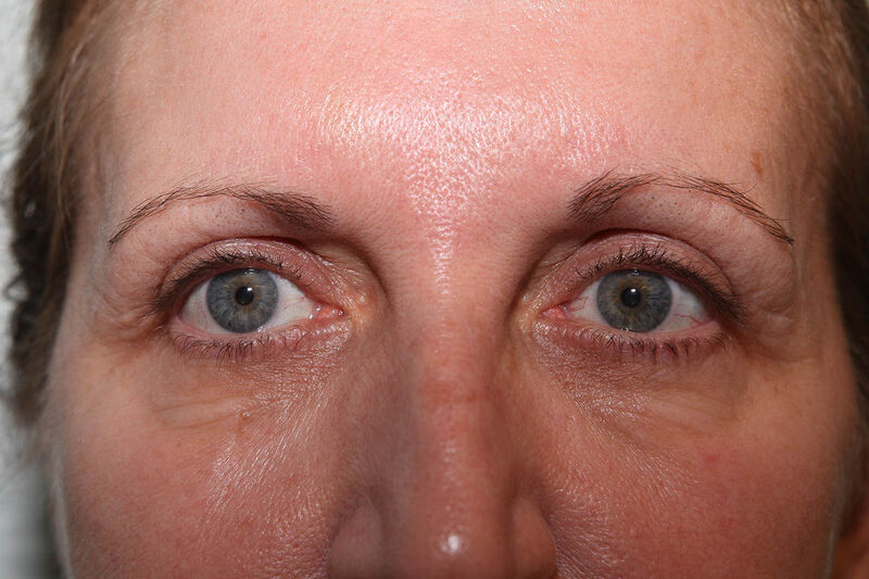 Upper Blepharoplasty Before & After Patient Photo