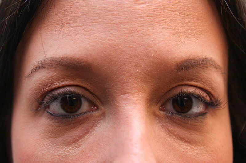 Upper Blepharoplasty Before & After Patient Photo