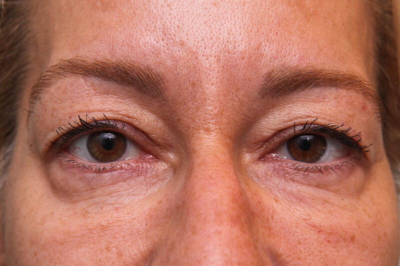 Upper Blepharoplasty Before & After Patient Photo