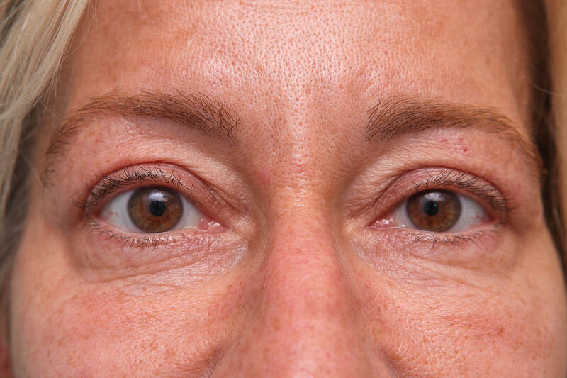 Upper Blepharoplasty Before & After Patient Photo