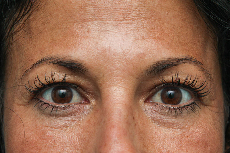 Upper Blepharoplasty Before & After Patient Photo