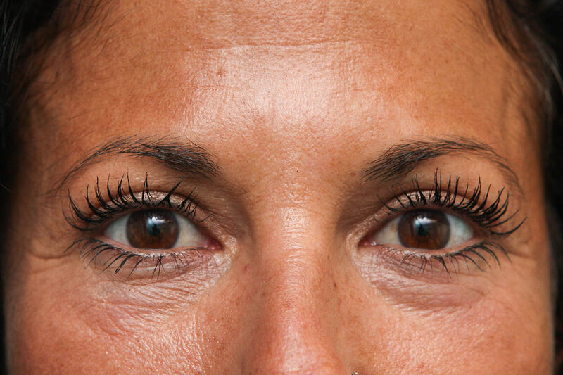 Upper Blepharoplasty Before & After Patient Photo