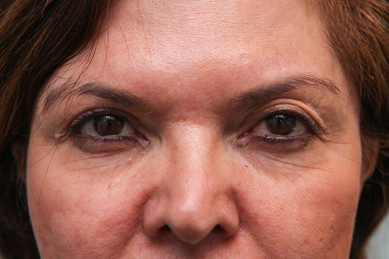 Upper Blepharoplasty Before & After Patient Photo