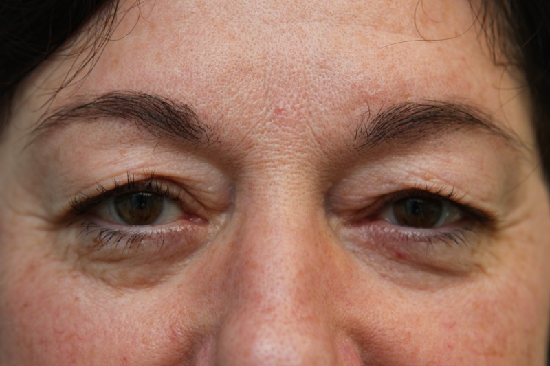 Upper Blepharoplasty Before & After Patient Photo