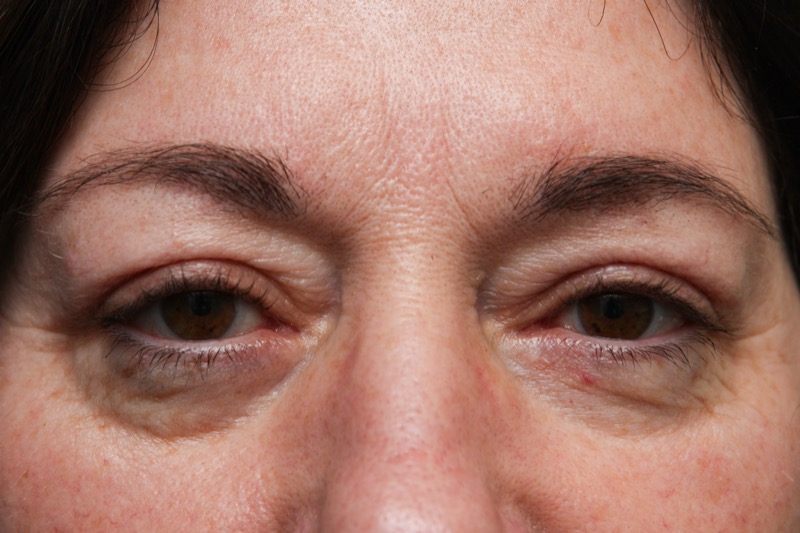 Upper Blepharoplasty Before & After Patient Photo