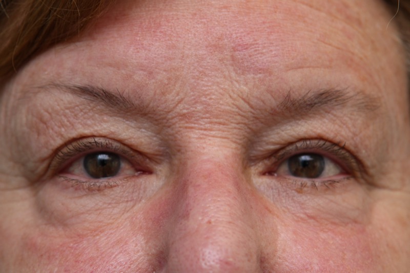Upper Blepharoplasty Before & After Patient Photo